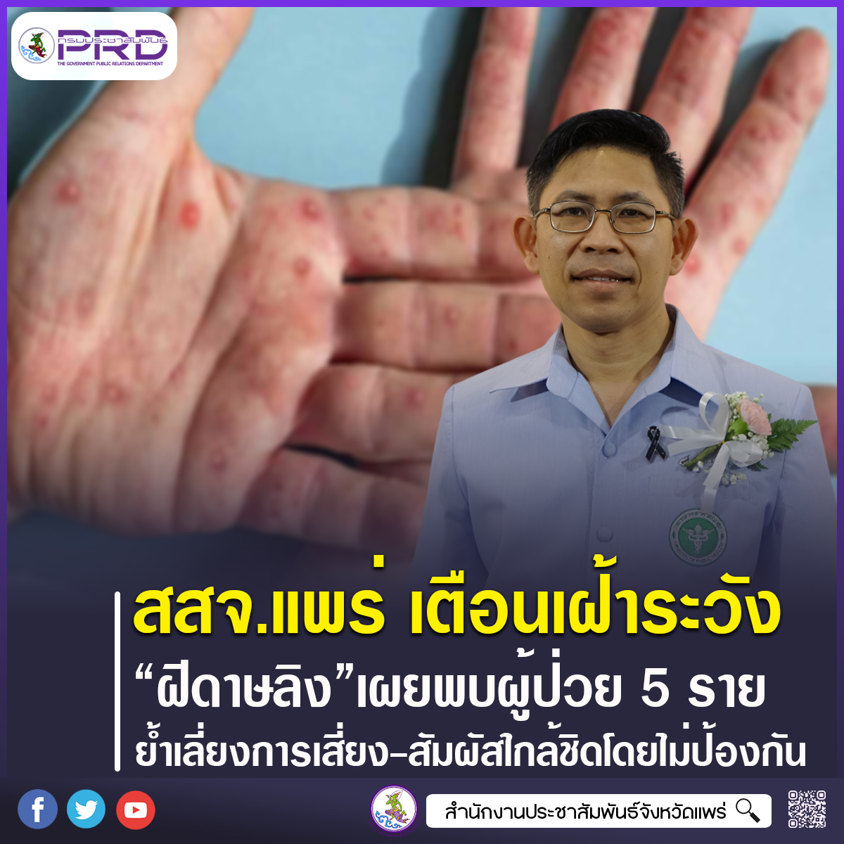 สสจ.แพร่ เตือนเฝ้าระวัง &ldquo;ฝีดาษลิง&rdquo; เผยพบผู้ป่วยสะสม 5 ราย ย้ำเลี่ยงพฤติกรรมเสี่ยง&ndash;สัมผัสใกล้ชิดโดยไม่ป้องกัน